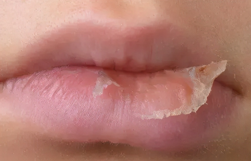 嘴唇起皮了为什么不能撕,反反复复嘴唇干裂起皮还痒怎么办