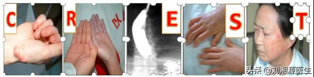 系统性硬化病患者可以怀孕吗,免疫相关不良妊娠诊断指南