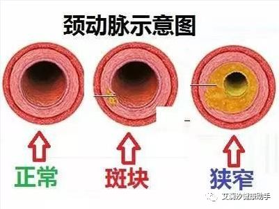 颈动脉斑块16mmx3mm有危险吗,发现颈动脉斑块需要吃药吗