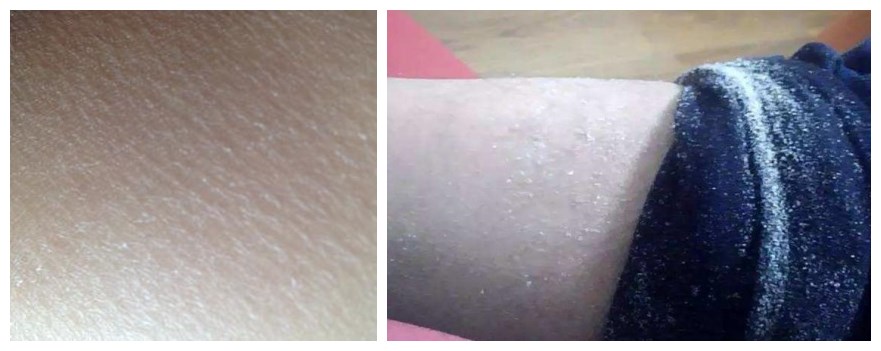 干燥起皮用什么身体乳好一点,为什么手臂干燥有死皮