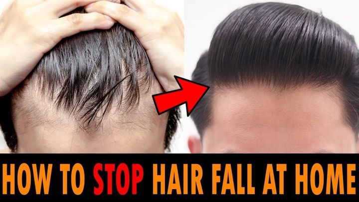 先天性发际线太高了怎么挽救,12岁女生发际线太高了怎么挽救