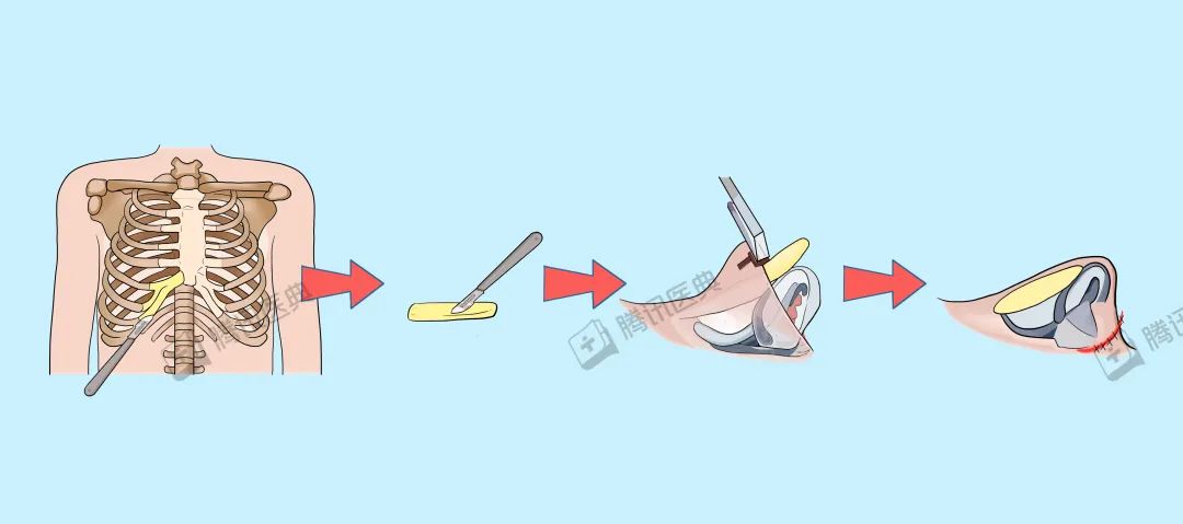 隆鼻的几大风险,隆鼻真的10个做9个后悔吗