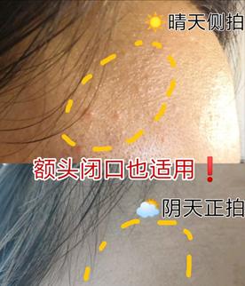 解决闭口最佳方法不复发,如何去闭口最有效方法