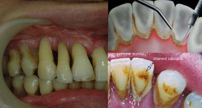 导致牙龈萎缩的4个原因,导致牙龈萎缩的4大原因