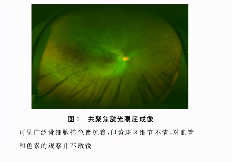 视网膜色素变性症状有哪些,视网膜色素变性会越来越严重吗