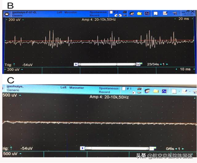 陈国强：令人烦恼的“咬牙切齿”竟是罕见的咬肌痉挛