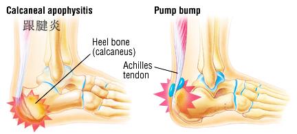 足跟疼痛教你一招百试百灵,早起落地脚疼