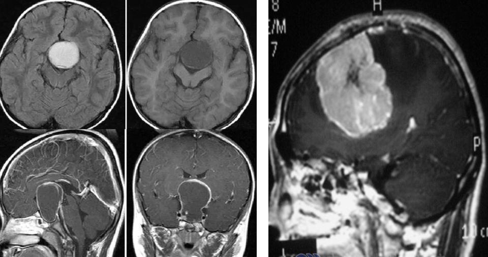 儿童反复呕吐是周期性呕吐吗?*013院医**邹丽萍教授解读儿童呕吐