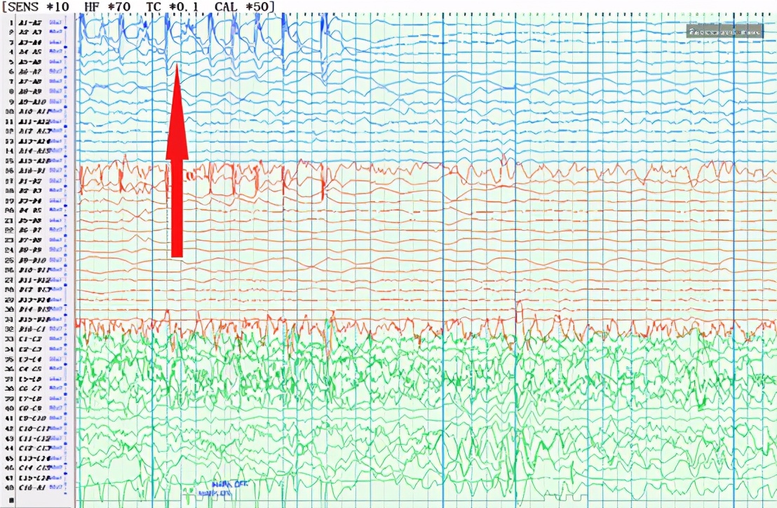 良性癫痫会痴笑发作吗,痴笑性癫痫是什么
