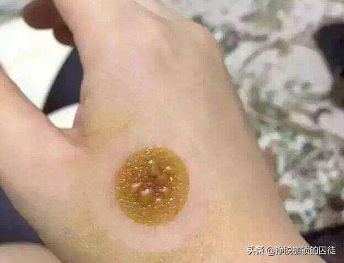 艾灸后出现水泡需要扎破吗,艾灸后起的水泡是排湿还是烫伤