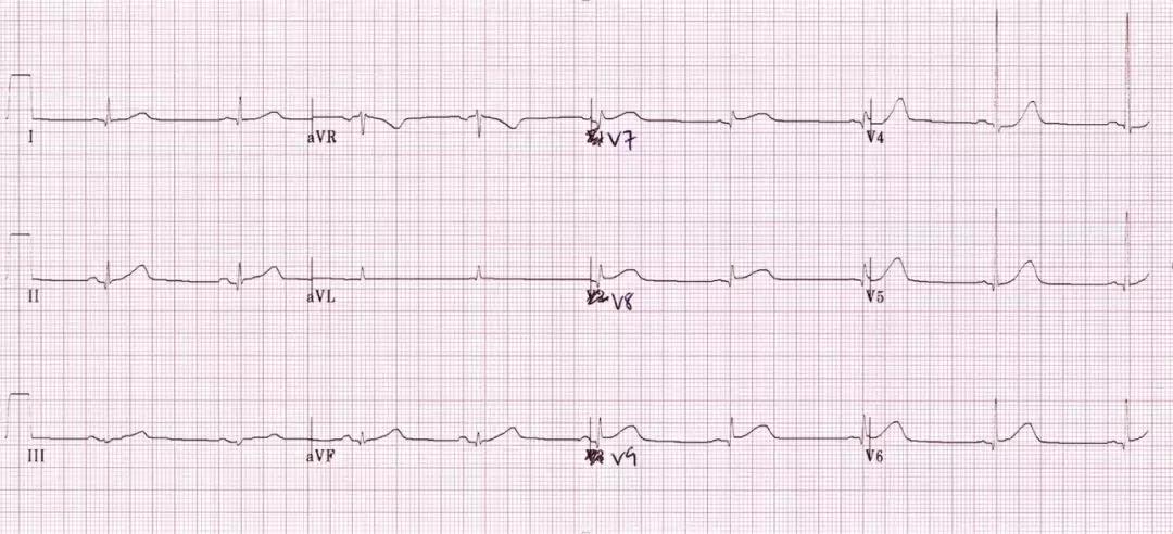 心电图和心脏彩超以哪个为准,心电图和心脏超声是一样吗