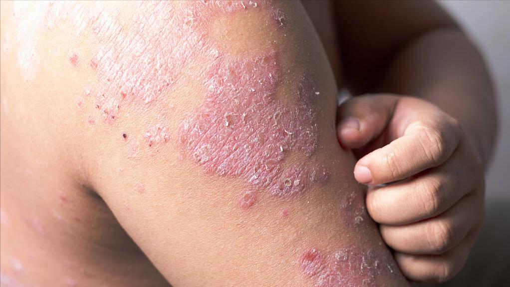 银屑病一直不好怎么办,银屑病中医治疗为啥反反复复