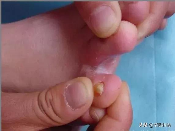 夏季脚气的最佳治疗方法,夏季脚气高发如何才能不受气