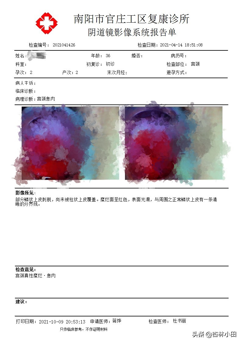 hpv宫颈癌Tct检查有啥注意事项,宫颈癌hpv