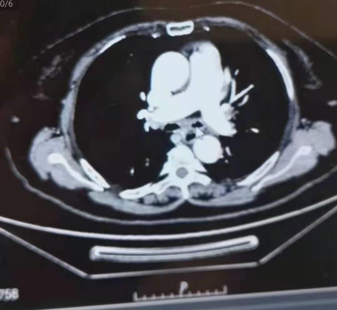 80岁得癌症放弃治疗,80岁以上肺癌建议手术吗