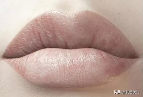 击退黑色素的最佳方法,击退黑斑的最好方法