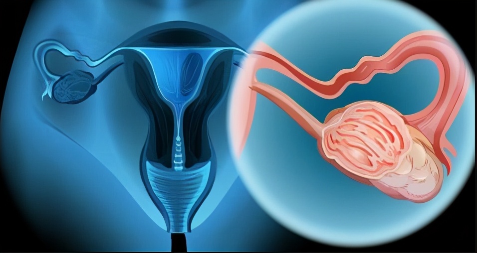宫颈癌的6个信号是怎么回事,得了宫颈癌的征兆有哪些