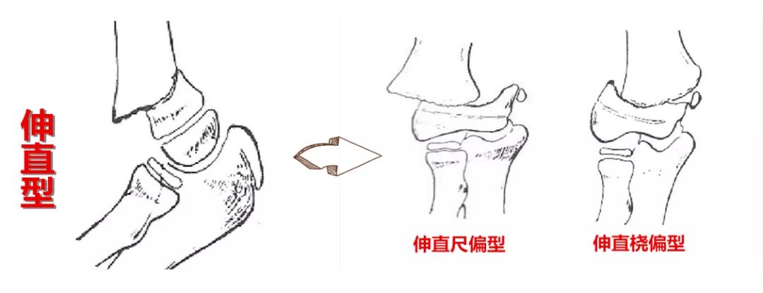 小孩胳膊骨折的治疗方法,胳膊骨折后骨折处发热怎么回事