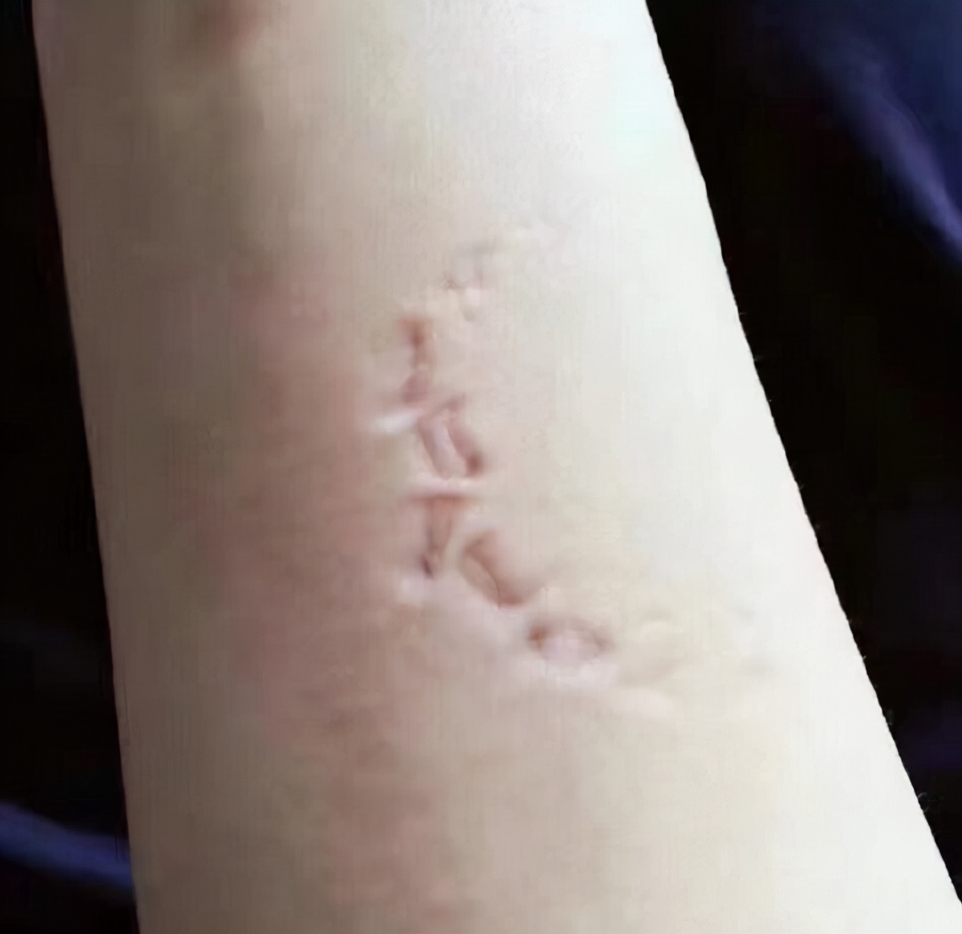 隐适美牙套矫正手法,隐适美牙套矫正的全过程