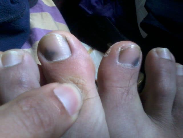 跑步出现黑趾甲,5步解决跑步黑指甲