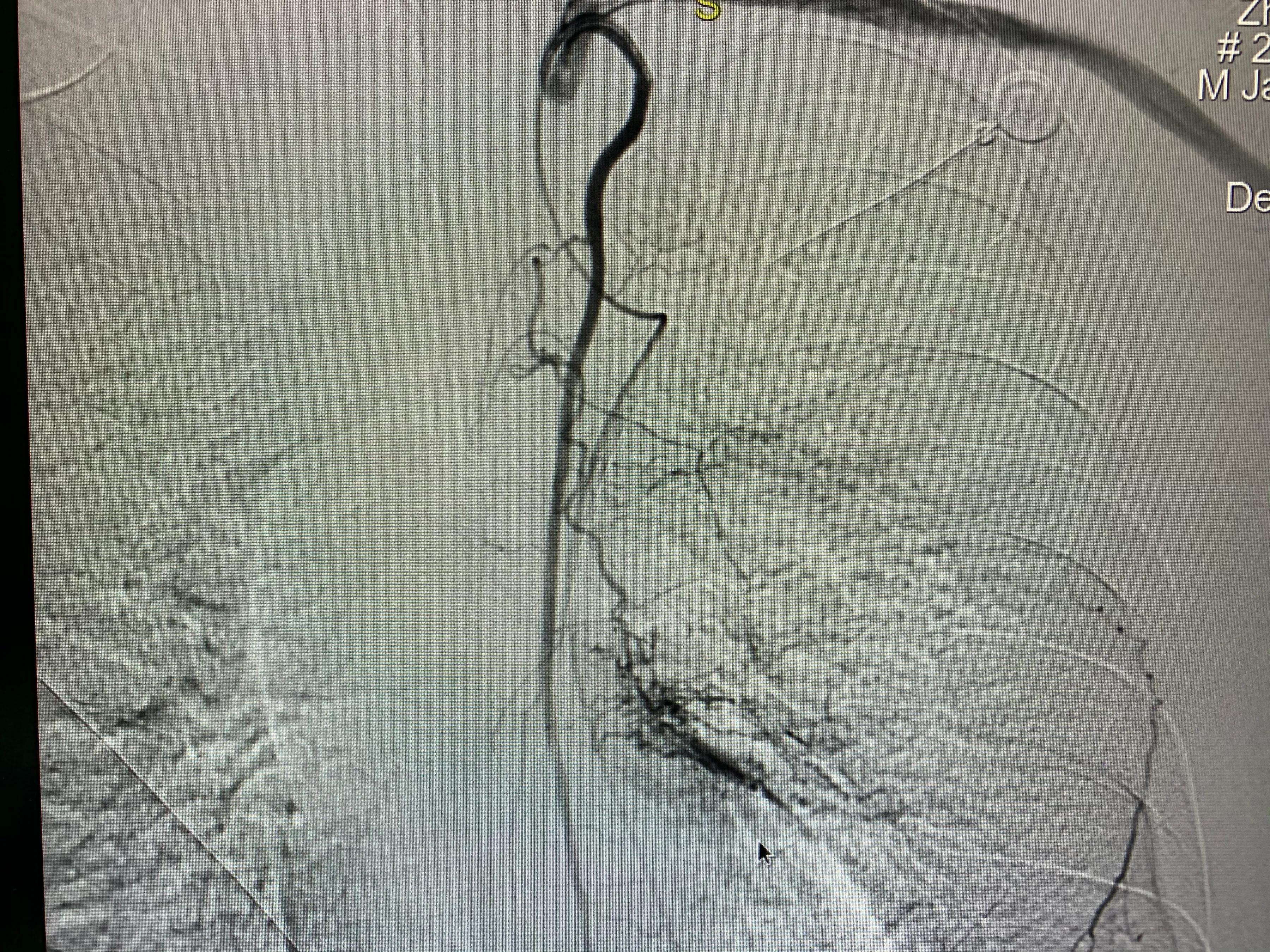 肺癌栓塞的介入治疗,84岁老人患肺癌可以做微创介入吗