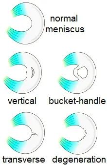 半月板损伤及韧带损伤,半月板损伤膝盖表现