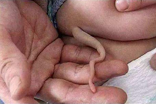 为什么刚出生的婴儿屁股上有青迹,为什么婴儿出生屁股会淤青