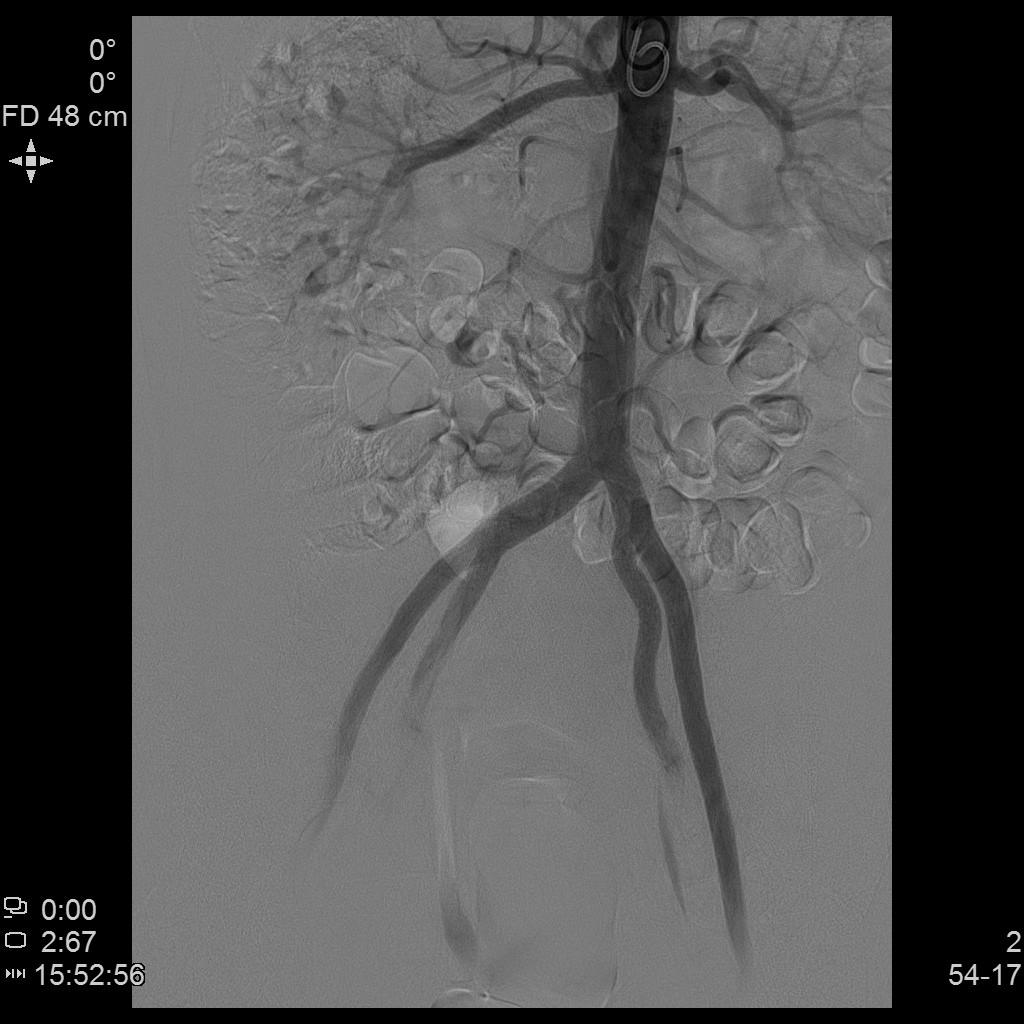 子宫肌瘤不能开刀只能化疗严重吗,子宫肌瘤介入栓塞治疗后注意事项