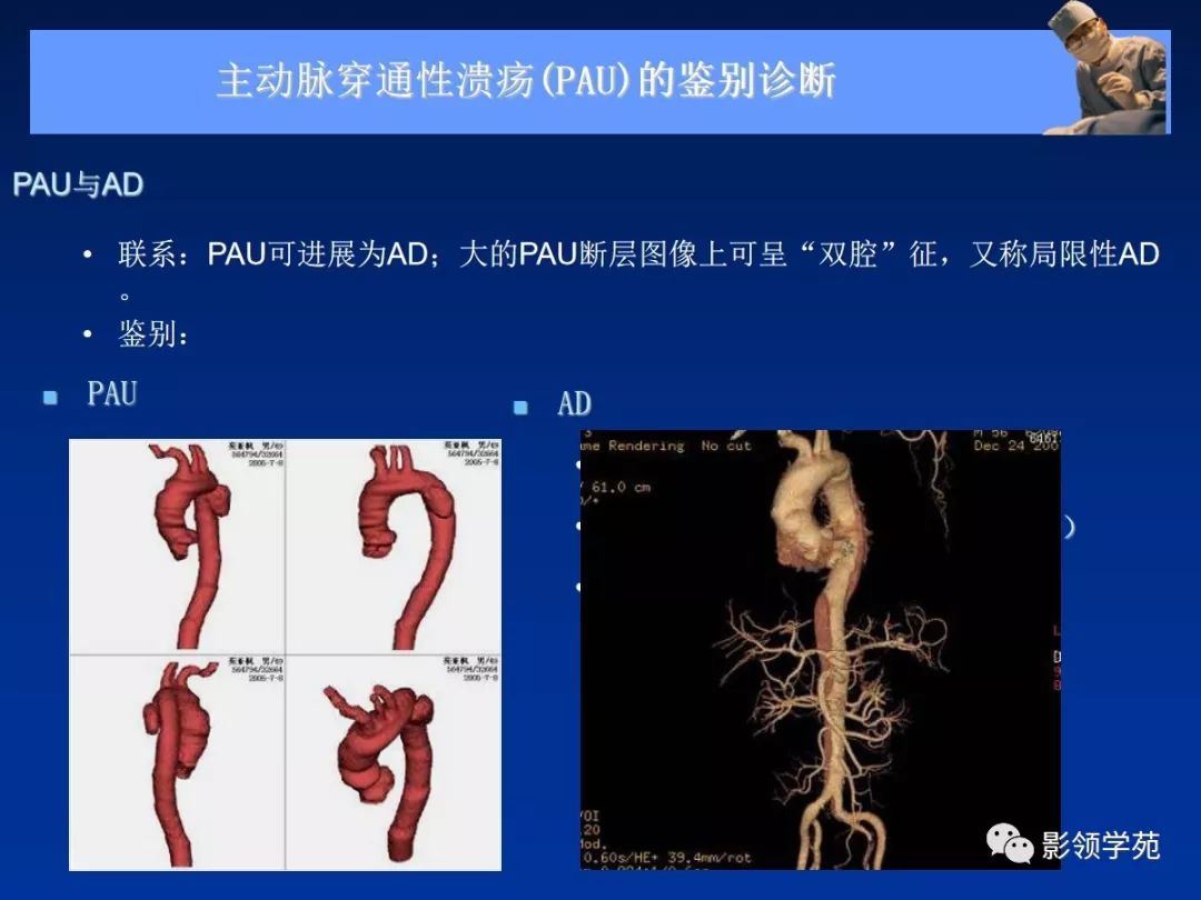主动脉夹层壁间血肿如何鉴别,主动脉夹层血肿溃疡