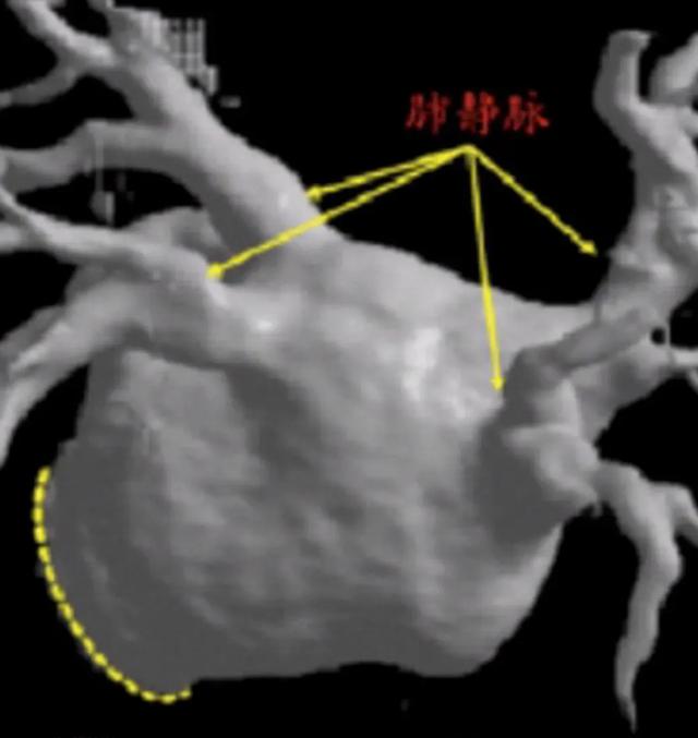 房颤射频科普视频,非器质性房颤能治好吗