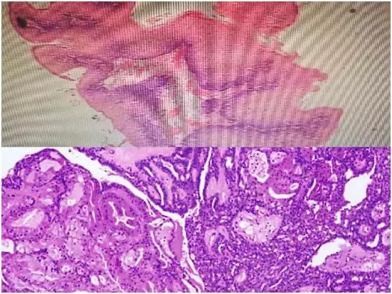 食管壁上美丽的“莲花”在无痛胃肠镜下现出了魔影