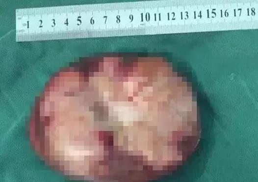 湖南株洲公交车司机突然发病,肝癌破裂大出血抢救无效死亡