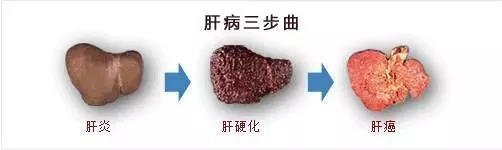 乙肝大三阳离肝癌有多远,乙肝离肝癌一般多远