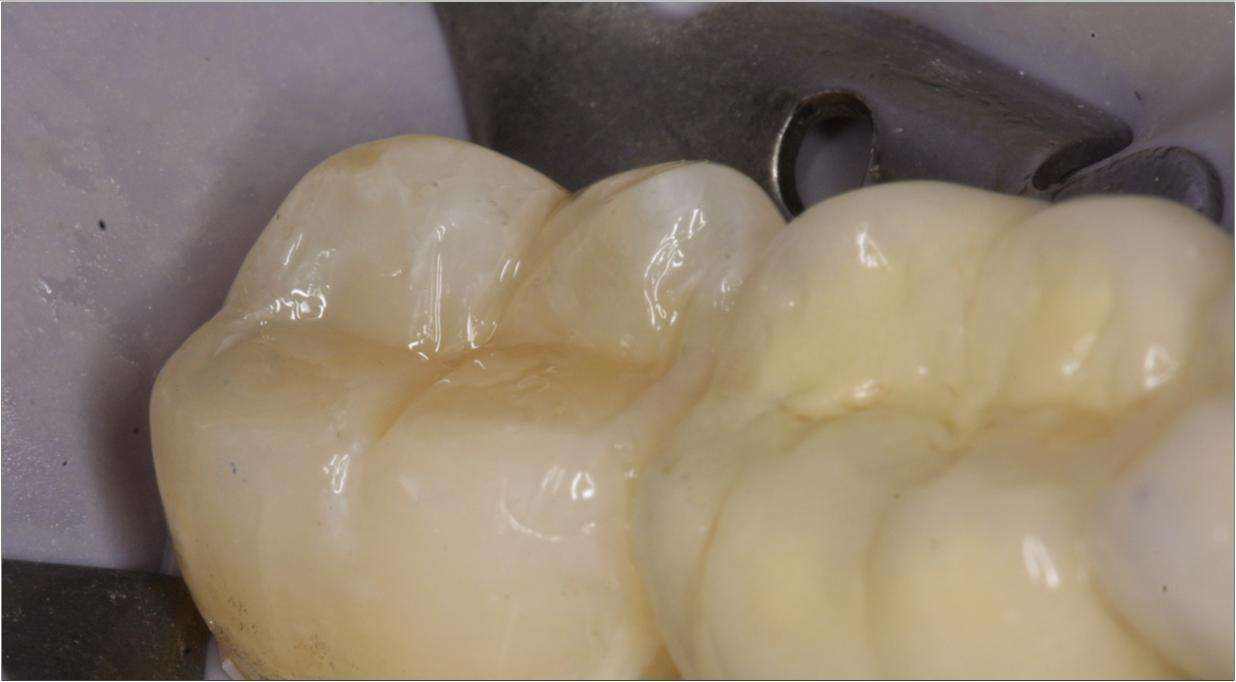 补牙“油水”有多大？补牙前，请一字不漏地看完