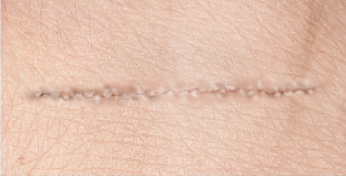 红色疤痕可以恢复到正常肤色吗,褐色的疤痕