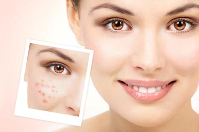 美妆美业-赵勤丨脸颊上长痘痘是什么原因，你知道吗