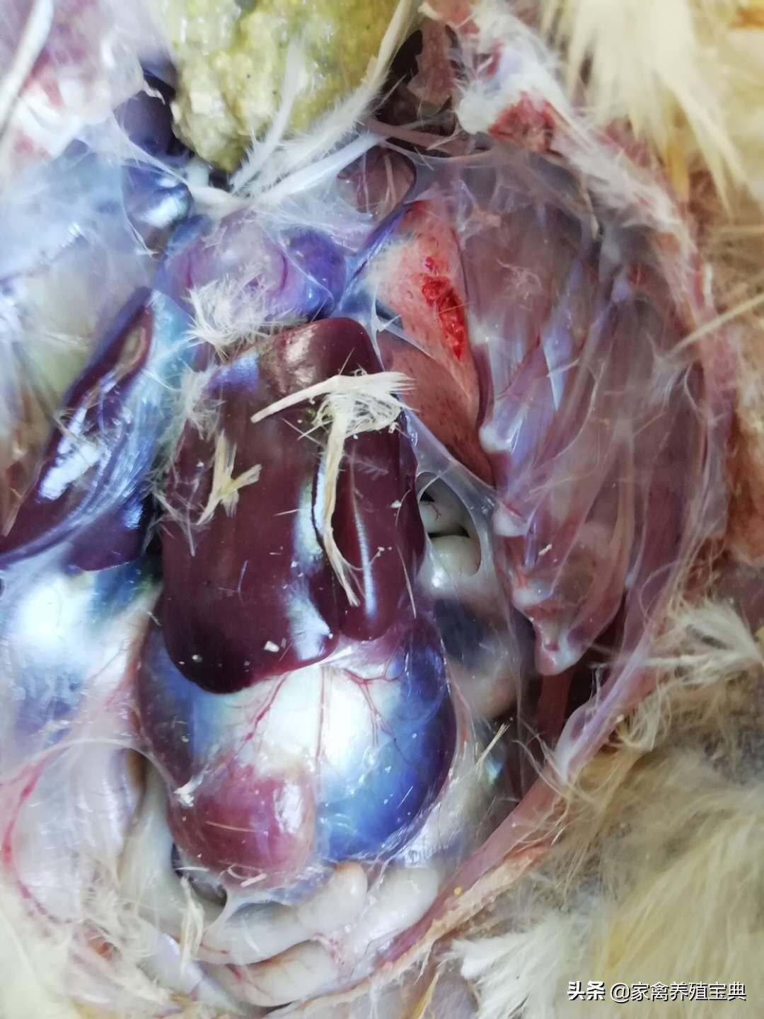 心包炎、肝周炎、腹膜炎真实案例分享！及治疗方法