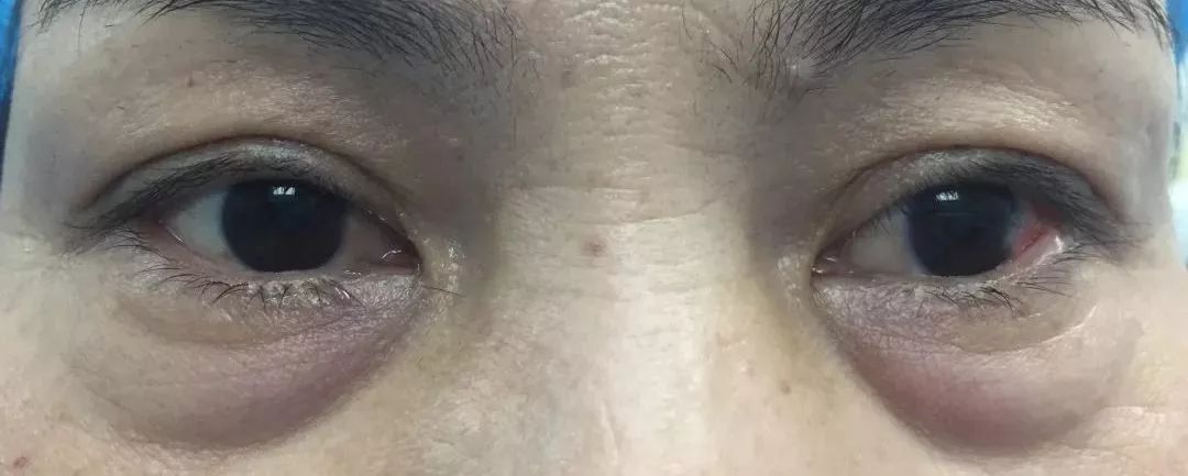 眼袋消除三个方法,教你一个简单消除眼袋的方法