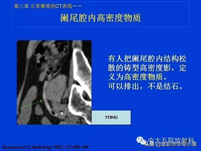阑尾炎课件,阑尾炎的超声课件