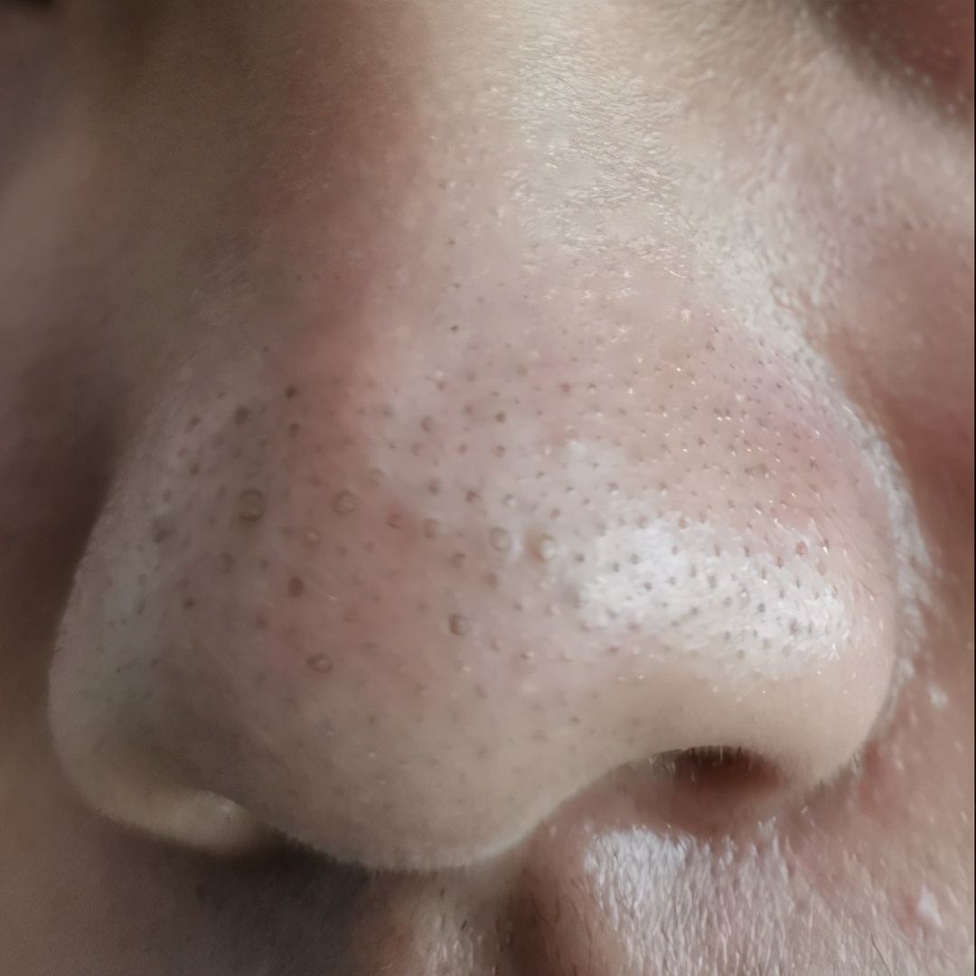 黑头如果不管的话会怎样,如果黑头一直不挤会怎样