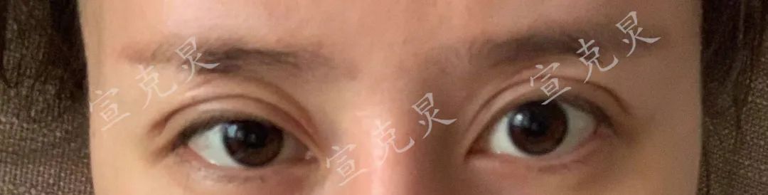 正规整容医院割双眼皮毁容,女子双眼皮修复成大小眼