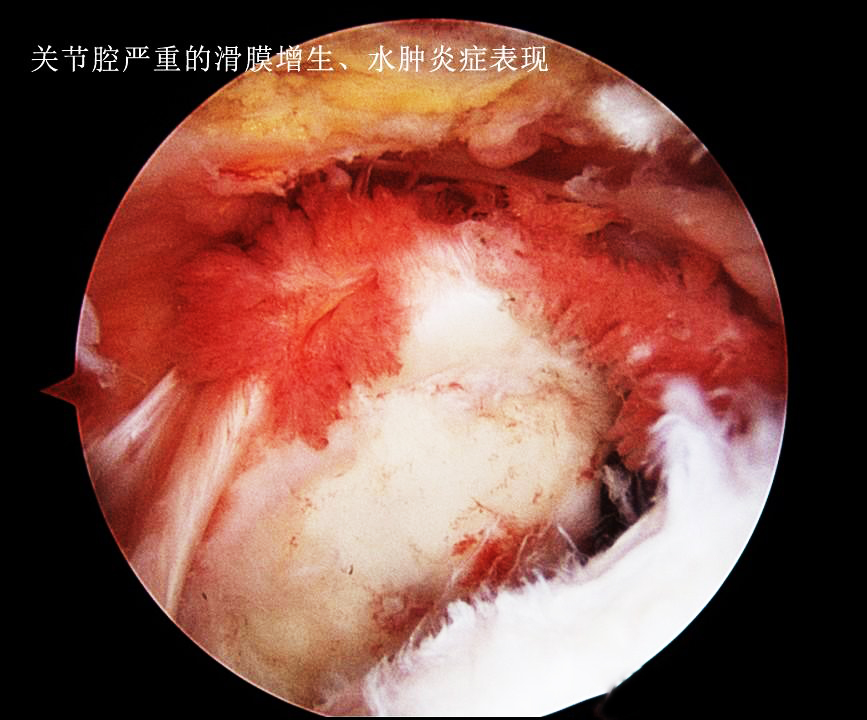 膝盖积水用烤灯能烤好吗？粗盐呢？医生：明确诊断针对治疗是关键