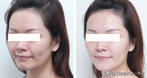 为什么射频消融术后容易复发,为什么射频消融术不除根