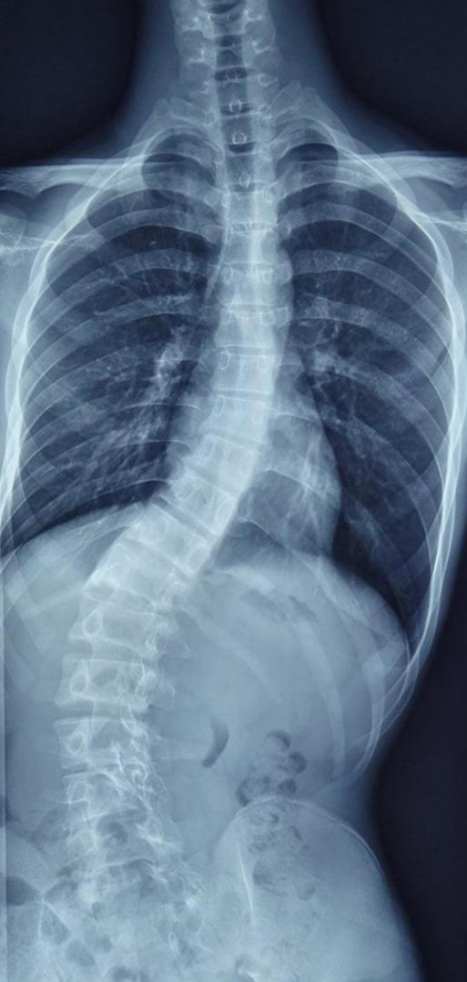 老年人脊柱歪了怎么办,成年人脊柱歪了的危害