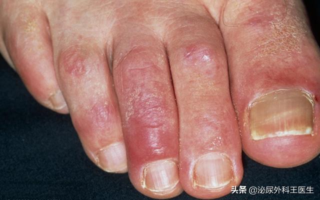 1%红霉素软膏作用与功效,红霉素软膏的价格高低功效相同吗