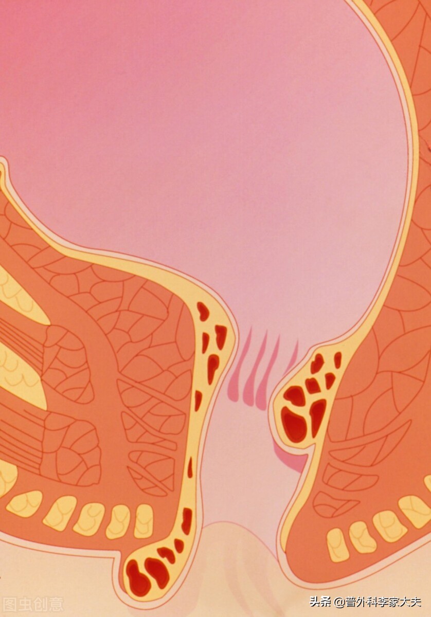 做过痔疮手术又复发不做手术行吗,十年前痔疮动过手术现在又复发了