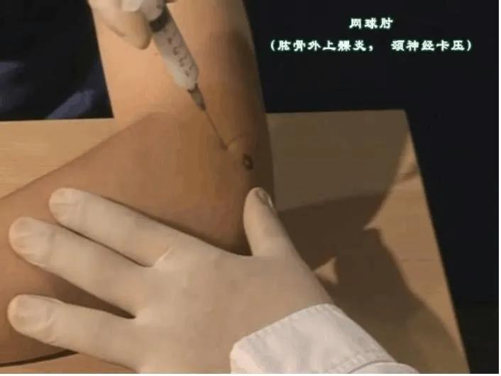 网球肘引起手臂疼痛用什么药治疗,有一种胳膊痛叫网球肘