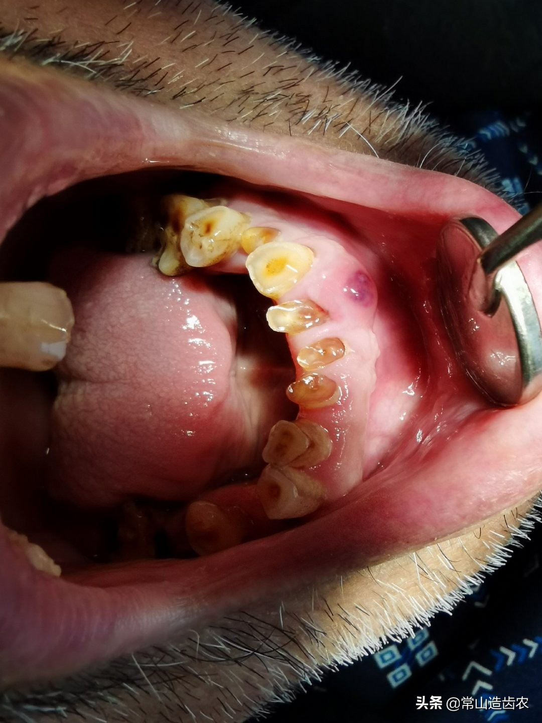 心脏病患者的拔牙禁忌症,有心脏病的人拔牙注意事项