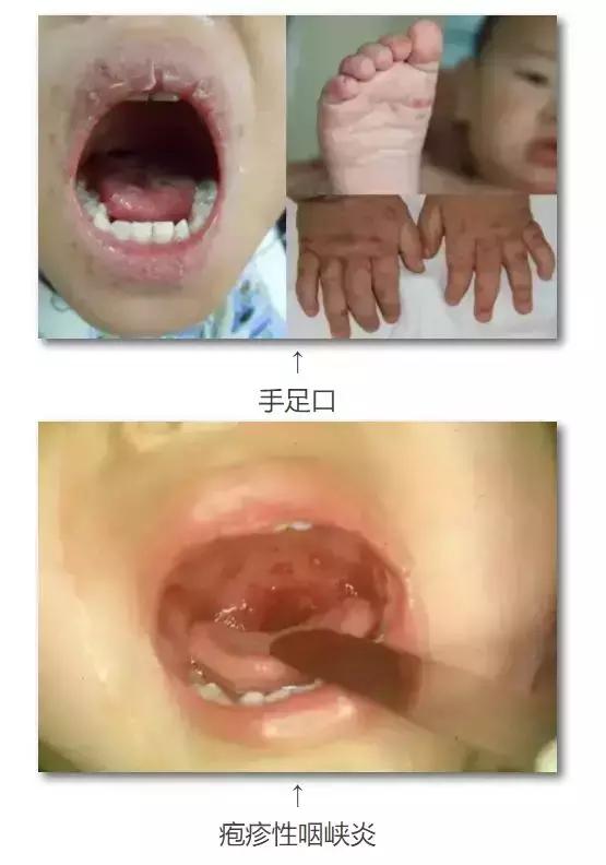 幼儿手足口病怎么传染的动画解说,手足口病儿童动画视频