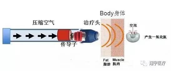 冲击波治网球肘有哪些副作用,体外冲击波治疗肩周炎